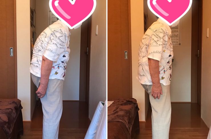 前側太もものしびれ